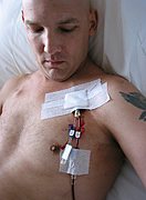 Hodgkin's Disease - the story of one patient, Marc Gregerson