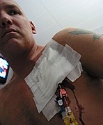 Man with a Bleeding Central Line Catheter